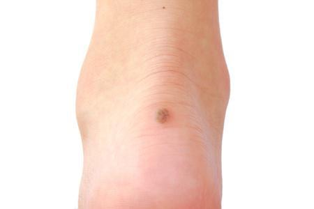 Skin Cancer Can Happen On Your Feet