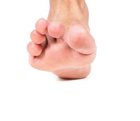 Hammertoes Can Happen Because of a Stroke