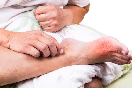 Gout Attacks Can Be Prevented and Minimized