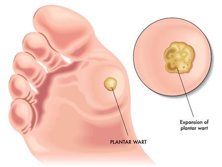 Your Podiatrist Can Ease Worries About Plantar Warts