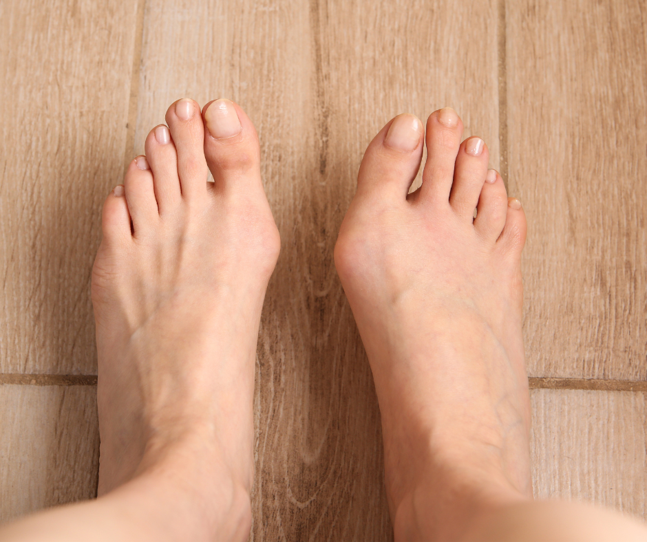 feet with bunions