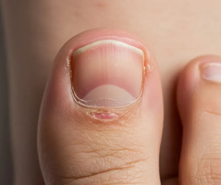 Why Do Ingrown Toenails Keep Coming Back?