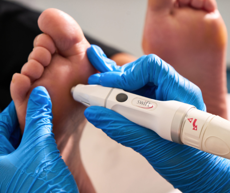 Tired of Failed Wart Treatments? Biohack Your Immune System with SWIFT Therapy