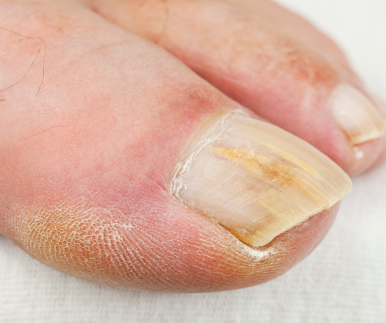 Why Are My Toenails Thick and Yellow? The Danger of “Hiding” Foot Fungus This Fall