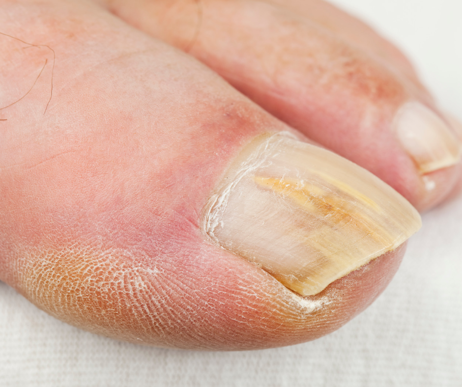 toenail with fungus